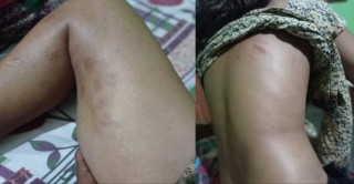 ससुरा सहित परिवारका सदस्य वाट बुहारीलाई निर्घात कुटपिट