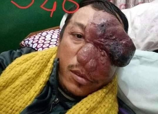 ट्युमरको उपचारका लागि आर्थिक सहयोग हस्तान्तरण