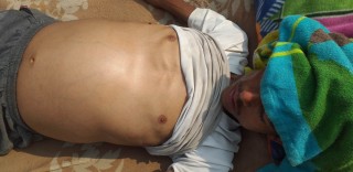 फोक्सोमा पानी जमेको कारण तत्काल अप्रेसन गर्नुपर्ने,आर्थिक अभावका कारण घरमै बस्न बाध्य