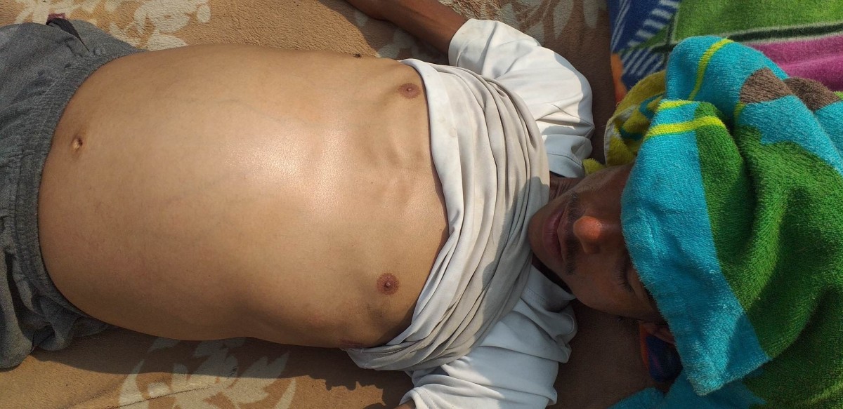 फोक्सोमा पानी जमेको कारण तत्काल अप्रेसन गर्नुपर्ने,आर्थिक अभावका कारण घरमै बस्न बाध्य