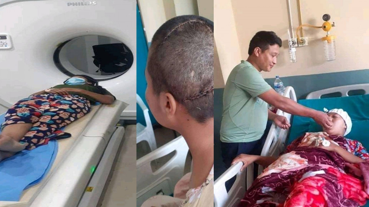 मगर संसारको पहलमा रोल्पाकी ब्रेन ट्यूमर बिरामीलाई आर्थिक सहयोग